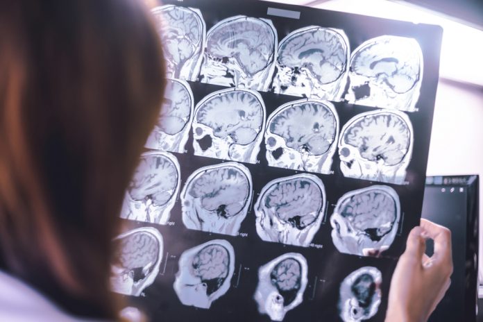 El deterioro del cerebro: peligro ante el COVID-19 COVID-19